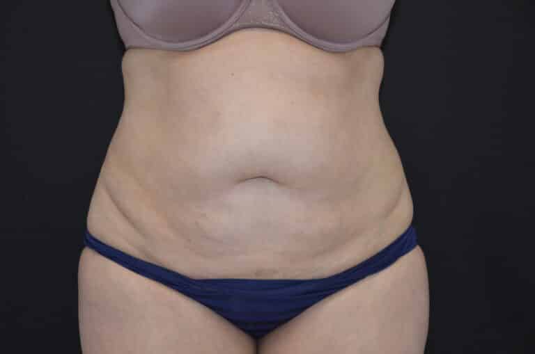 Before Image: Tummy Tuck - front