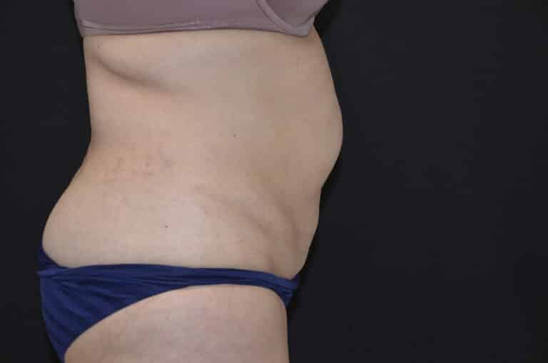 Before Image: Tummy Tuck - right-side