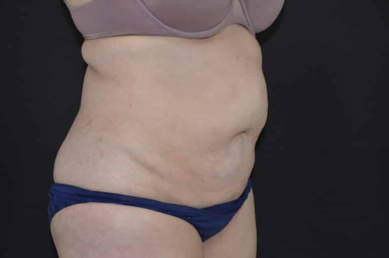 Before Image: Tummy Tuck - right-front-oblique