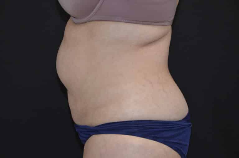 Before Image: Tummy Tuck - left-side