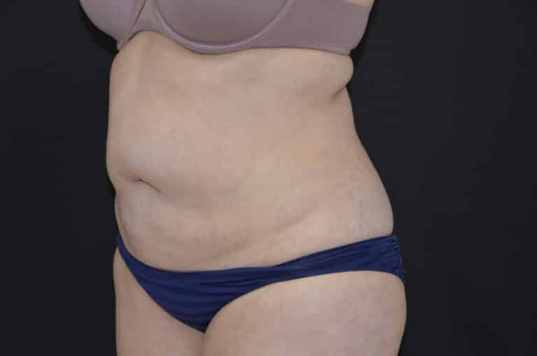 Before Image: Tummy Tuck - left-front-oblique