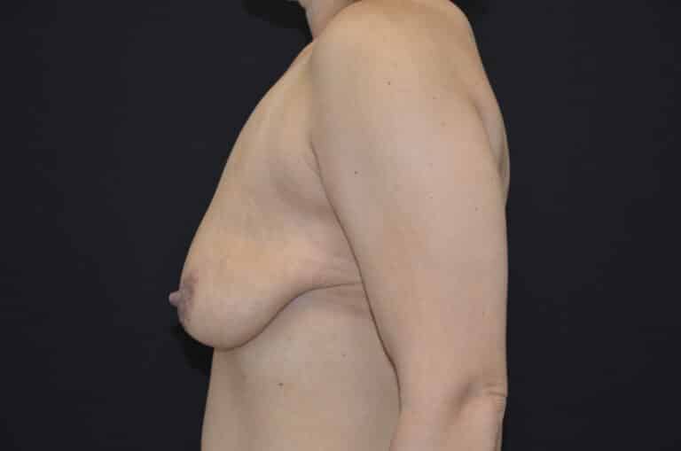 Before Image: Breast Lift with Implants - left-side