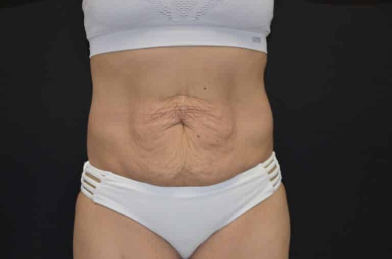 Before Image: Tummy Tuck - front