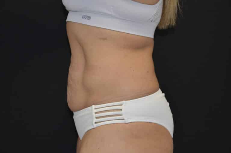 Before Image: Tummy Tuck - left-side