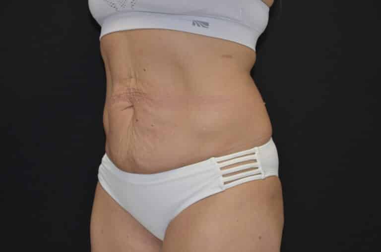 Before Image: Tummy Tuck - left-front-oblique