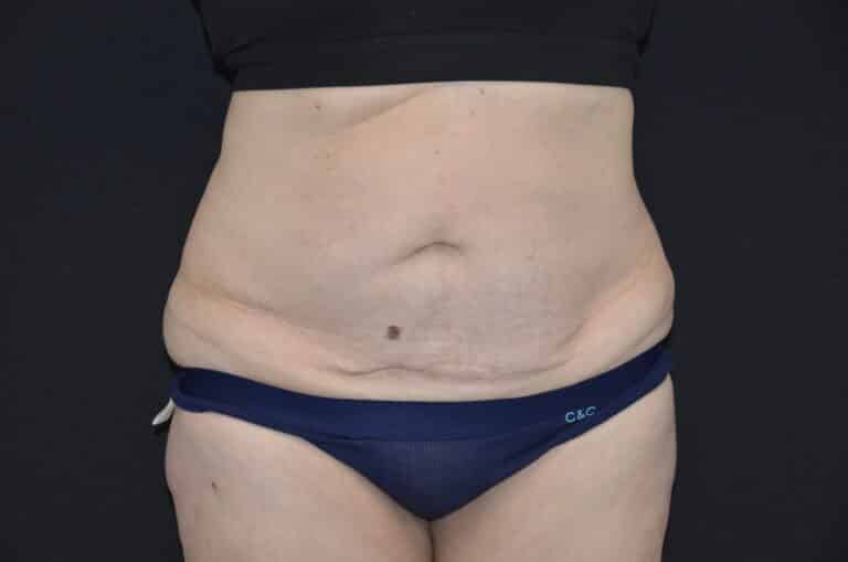 Before Image: Tummy Tuck - front