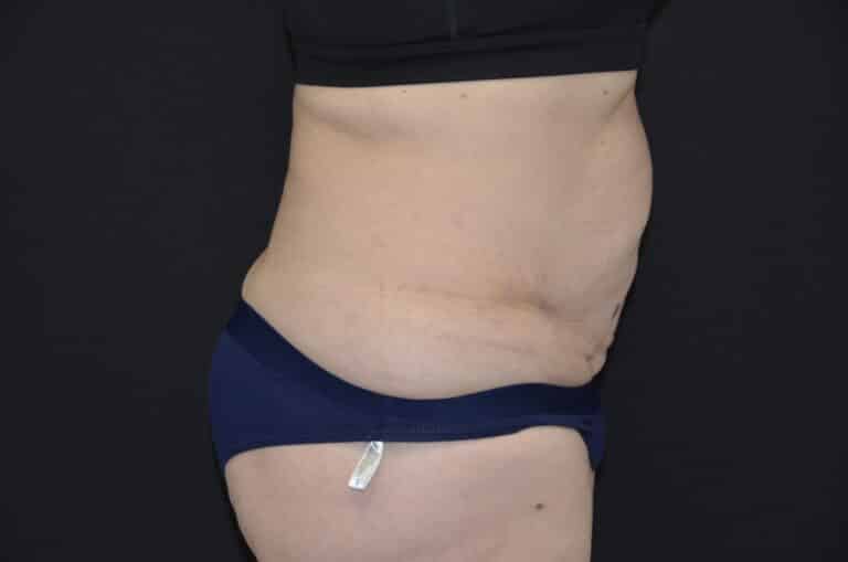 Before Image: Tummy Tuck - right-side