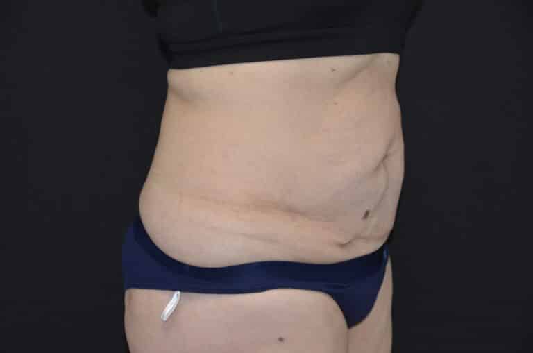 Before Image: Tummy Tuck - right-front-oblique