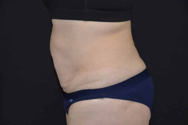 Before Image: Tummy Tuck - left-side