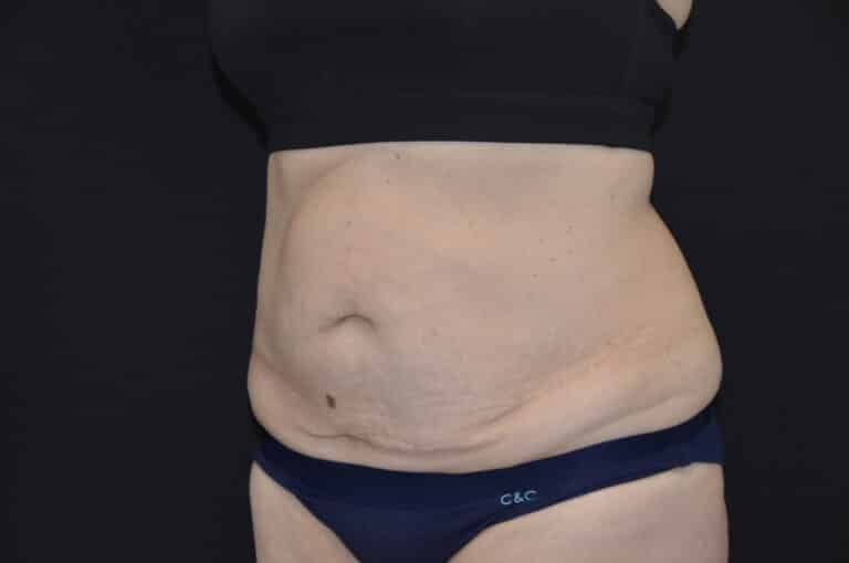 Before Image: Tummy Tuck - left-front-oblique