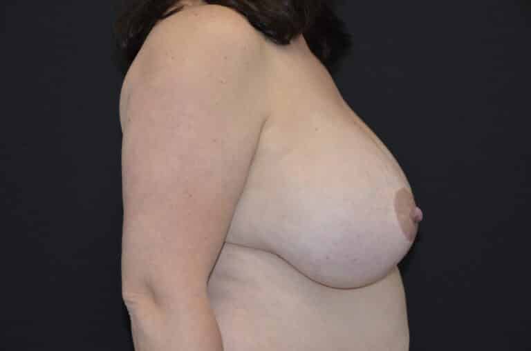 Before Image: Breast Reduction - right-side