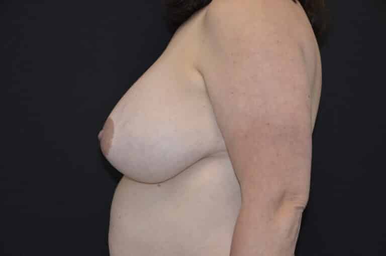 Before Image: Breast Reduction - left-side