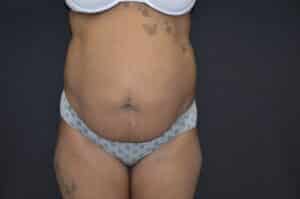 Before Image: Tummy Tuck