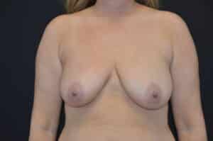 Before Image: Breast Lift with Implants