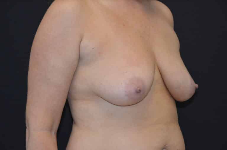 Before Image: Breast Lift with Implants - right-front-oblique