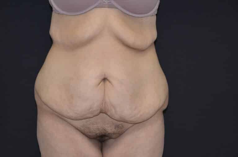 Before Image: Tummy Tuck - front