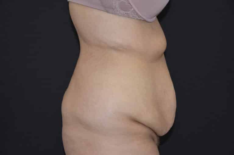 Before Image: Tummy Tuck - right-side