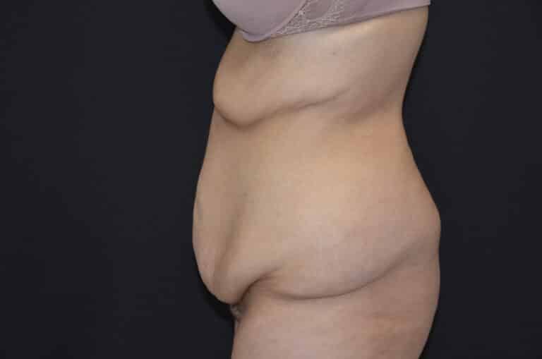 Before Image: Tummy Tuck - left-side