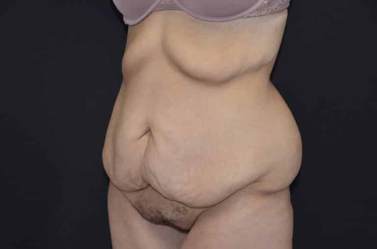 Before Image: Tummy Tuck - left-front-oblique