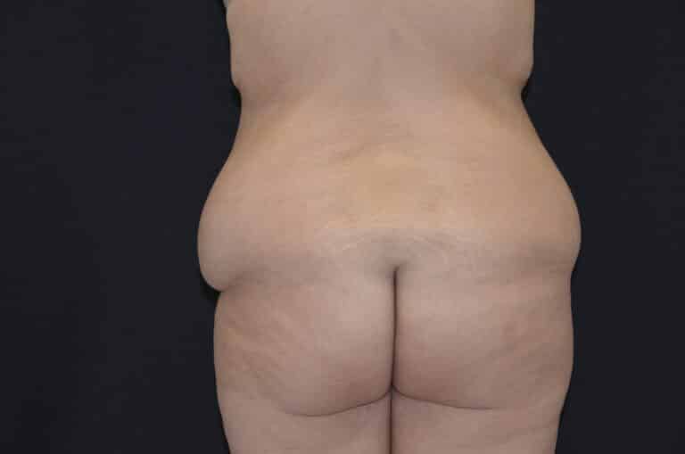 Before Image: Tummy Tuck - back