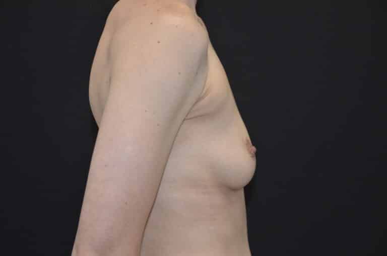 Before Image: Breast Augmentation - right-side