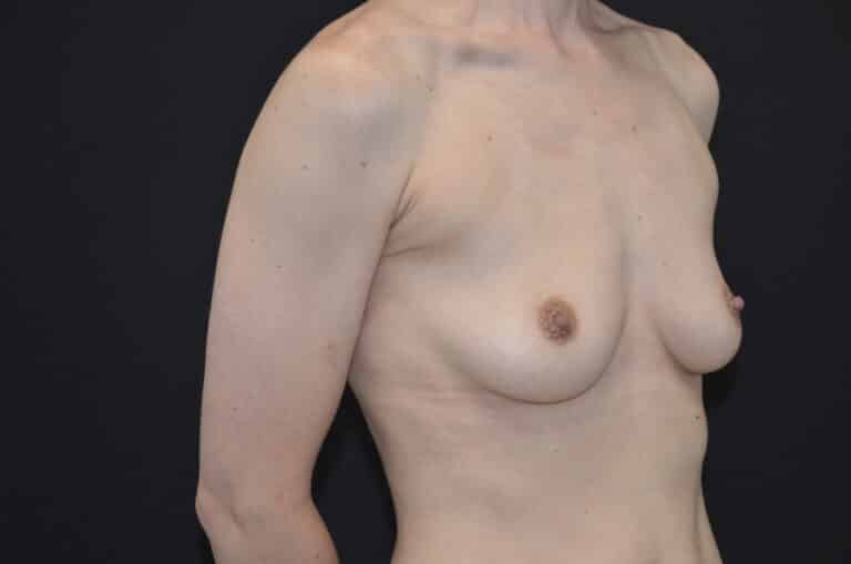 Before Image: Breast Augmentation - right-front-oblique