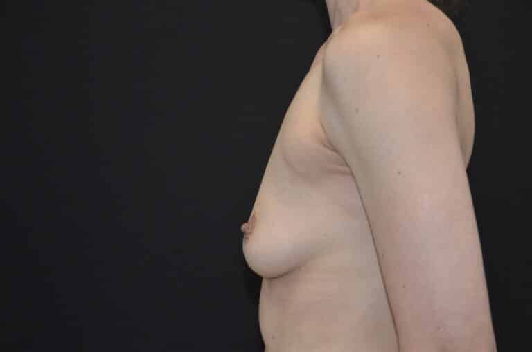 Before Image: Breast Augmentation - left-side