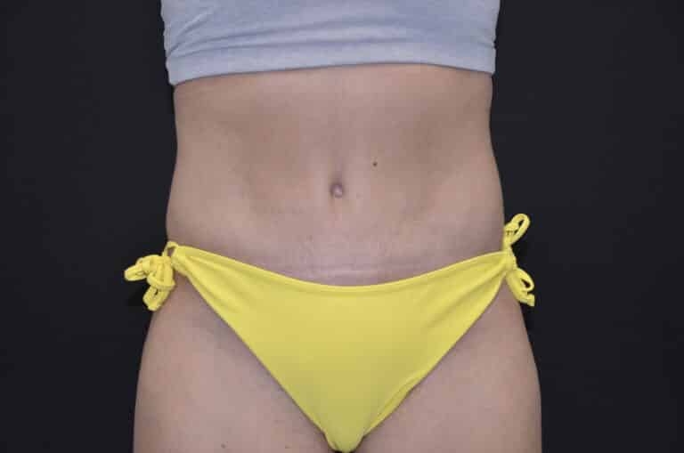 After Image: Tummy Tuck - front