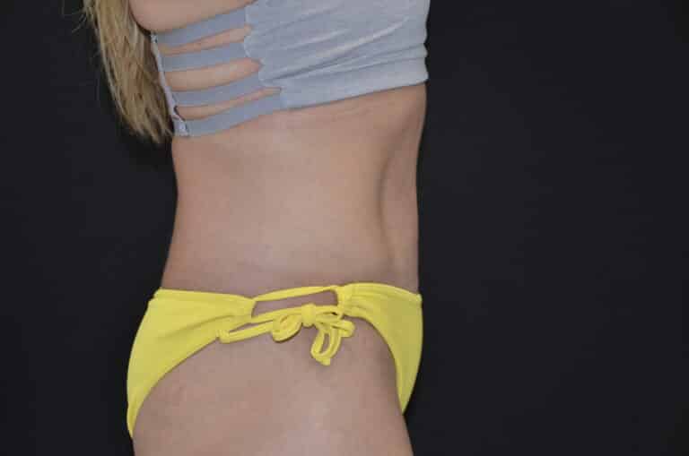 After Image: Tummy Tuck - right-side