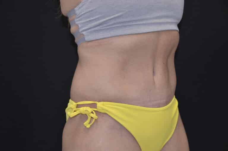 After Image: Tummy Tuck - right-front-oblique