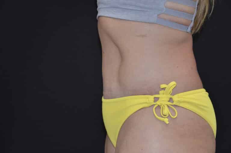 After Image: Tummy Tuck - left-side