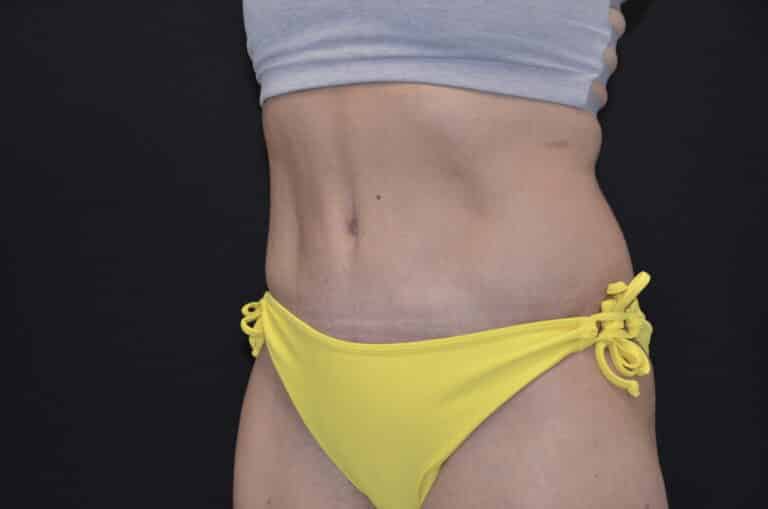 After Image: Tummy Tuck - left-front-oblique