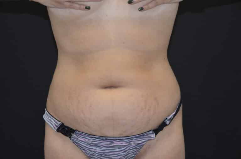 Before Image: Tummy Tuck - front