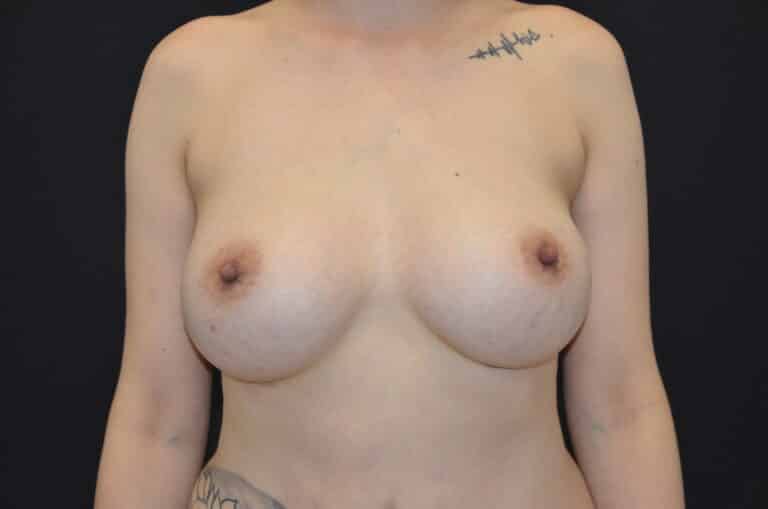 After Image: Breast Augmentation - front