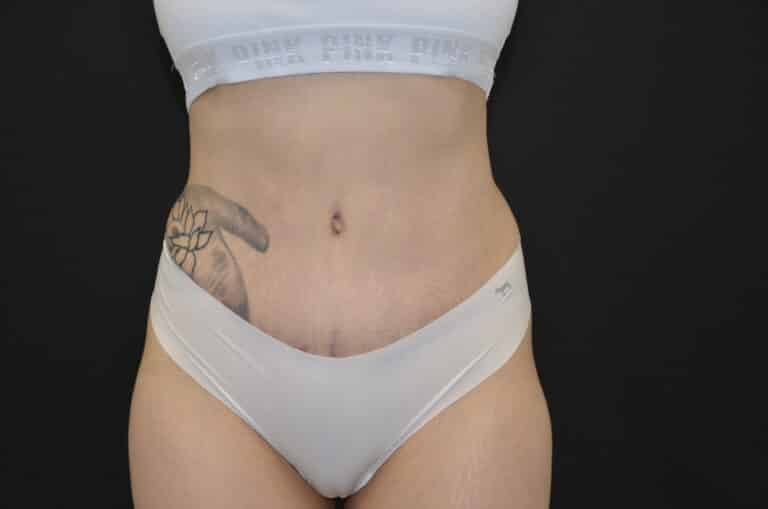 After Image: Tummy Tuck - front