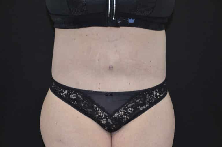 After Image: Tummy Tuck - front