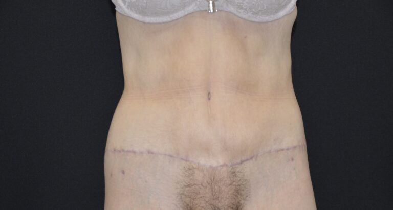 After Image: Tummy Tuck - front