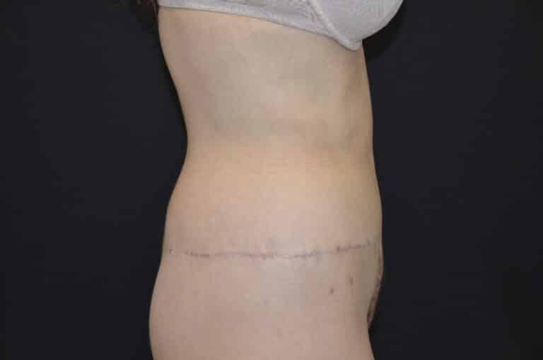 After Image: Tummy Tuck - right-side