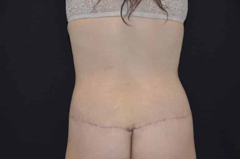 After Image: Tummy Tuck - back