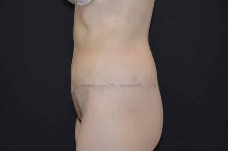 After Image: Tummy Tuck - left-side