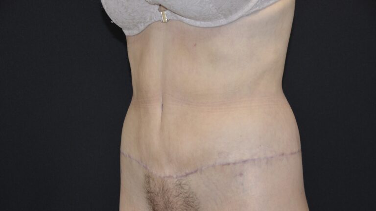 After Image: Tummy Tuck - left-front-oblique