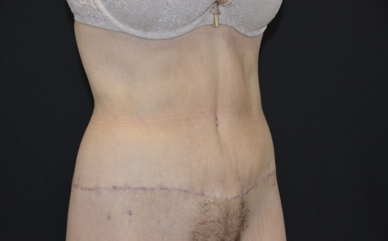 After Image: Tummy Tuck - right-front-oblique