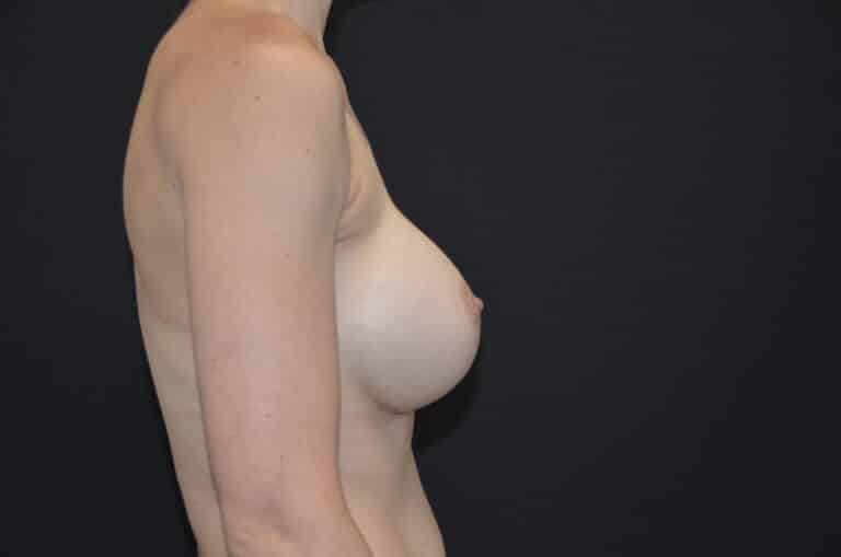 After Image: Breast Augmentation - right-side