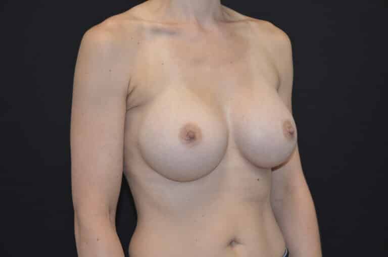 After Image: Breast Augmentation - right-front-oblique