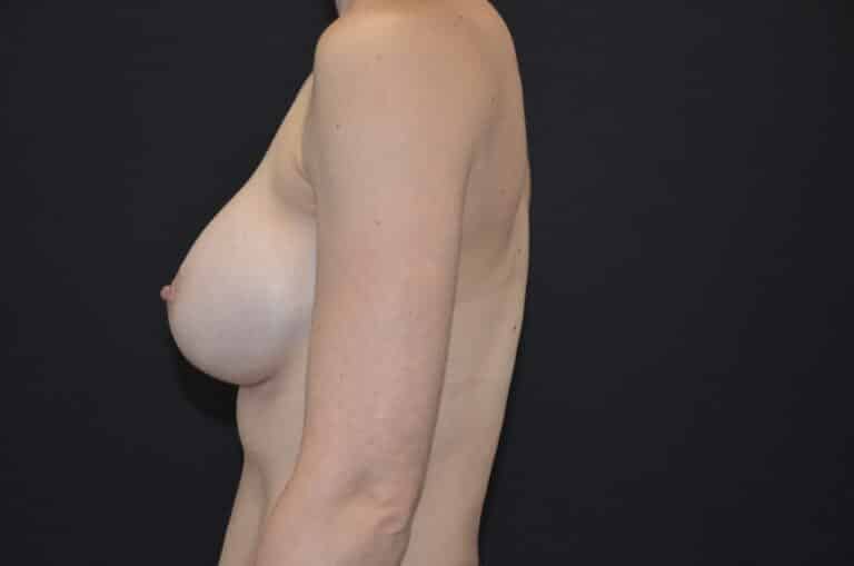 After Image: Breast Augmentation - left-side