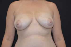 Before Image: Breast Lift with Implants