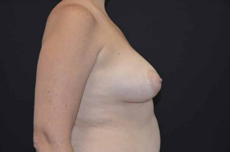 Before Image: Breast Lift with Implants - right-side