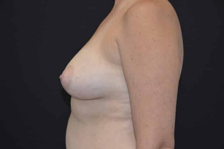 Before Image: Breast Lift with Implants - left-side