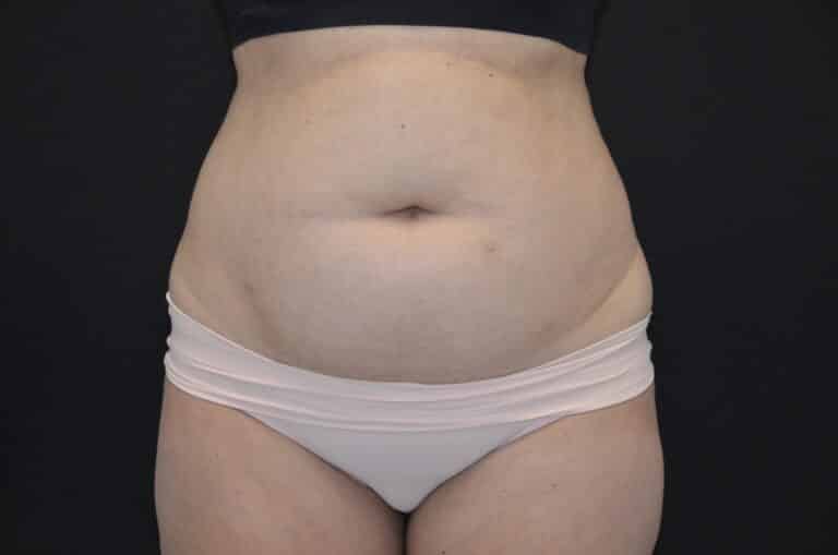 Before Image: Tummy Tuck - front