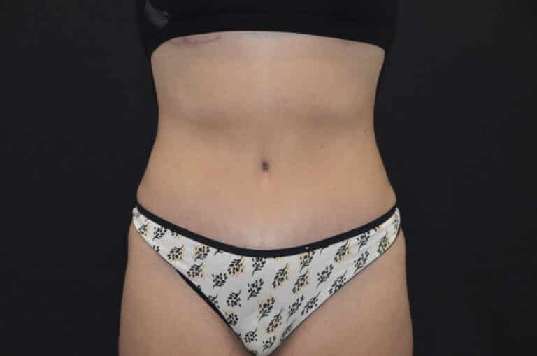 After Image: Tummy Tuck - front